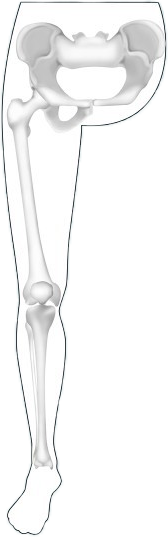 hip-disarticulation-2